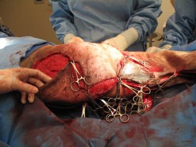 This is a picture of her second surgery.